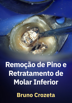 Cover for Remoção de Pino e Retratamento de Molar Inferior