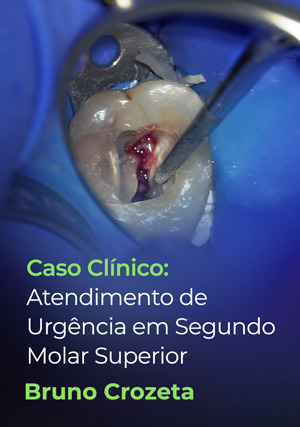 Cover for Caso Clínico: Atendimento de Urgência em Segundo Molar Superior
