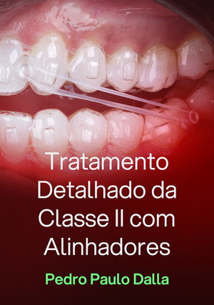 Cover for Tratamento Detalhado da Classe II com Alinhadores