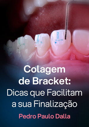 Cover for Colagem de Bracket: Dicas que Facilitam a sua Finalização