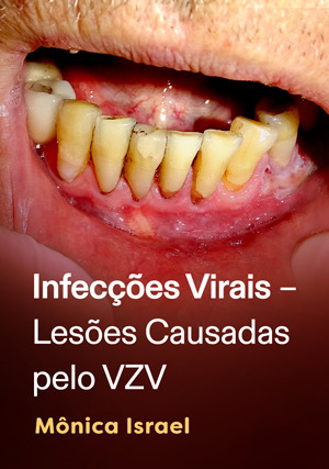 Cover for Infecções virais – lesões causadas pelo VZV