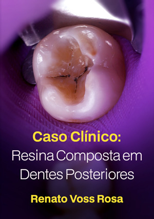 Cover for Caso Clínico: Resina Composta em Dentes Posteriores