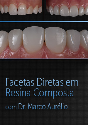 Cover for Facetas Diretas em Resina Composta