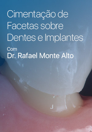 Cover for Cimentação de Facetas sobre Dentes e Implantes