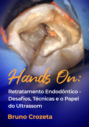 Cover for Hands on: Retratamento Endodôntico - Desafios, Técnicas e o Papel do Ultrassom