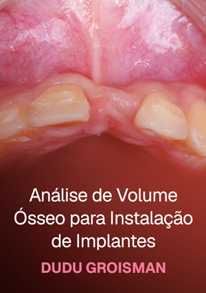 Cover for Análise de Volume Ósseo para Instalação de Implantes