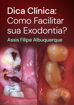 Cover for Dica Clínica: Como Facilitar sua Exodontia?