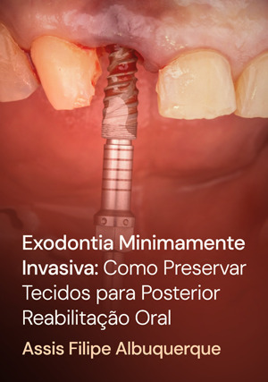 Cover for Exodontia Minimamente Invasiva: Como Preservar Tecidos para Posterior Reabilitação Oral