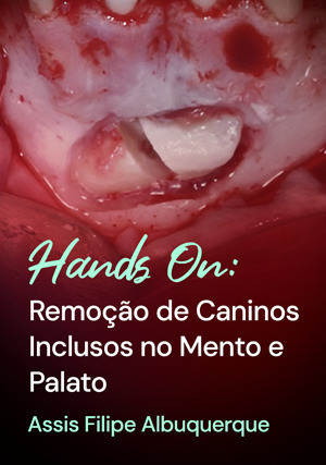 Cover for Hands on: Remoção de Caninos Inclusos no Mento e Palato