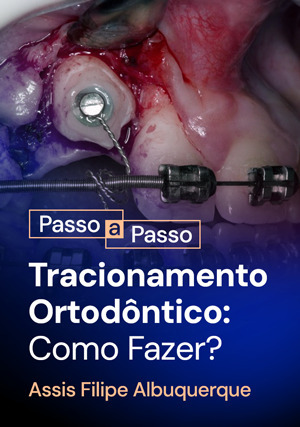 Cover for Passo a Passo: Tracionamento Ortodôntico: Como Fazer