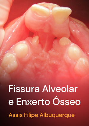 Cover for Fissura Alveolar e Enxerto Ósseo