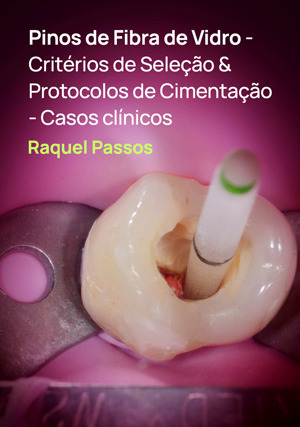 Cover for Pinos de Fibra de Vidro - Critérios de Seleção & Protocolos de Cimentação - Casos clínicos
