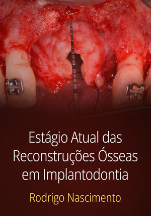 Cover for Estágio Atual das Reconstruções Ósseas em Implantodontia