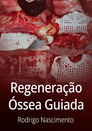 Cover for Regeneração Óssea Guiada