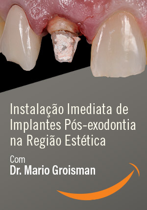 Cover for Instalação Imediata de Implantes Pós-exodontia na Região Estética