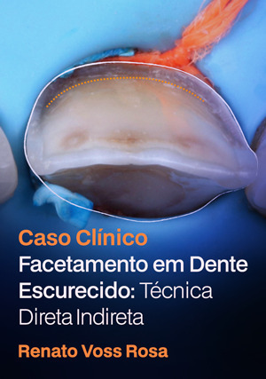 Cover for Caso Clínico: Facetamento em Dente Escurecido: Técnica Direta Indireta