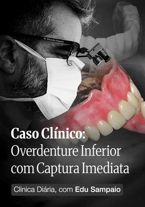 Cover for Caso Clínico: Overdenture Inferior com Captura Imediata