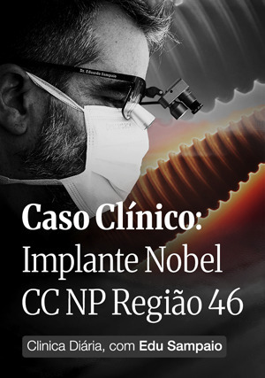 Cover for Caso Clínico: Implante Nobel CC NP Região 46