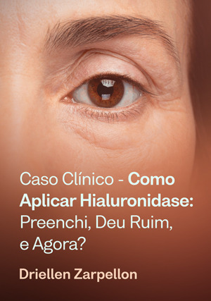 Cover for Caso Clínico - Como aplicar Hialuronidase: preenchi, deu ruim, e agora?