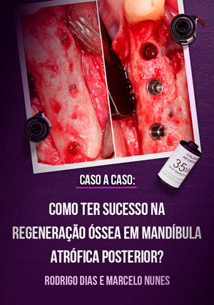 Cover for Caso a Caso: Como ter Sucesso na Regeneração Óssea em Mandíbula Atrófica Posterior?