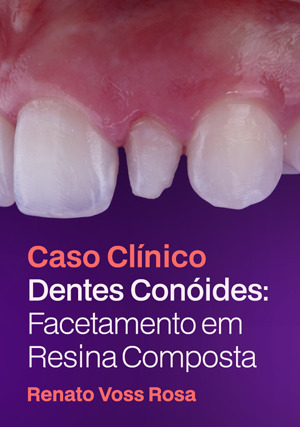 Cover for Caso Clinico: Dentes Conóides: Facetamento em Resina Composta