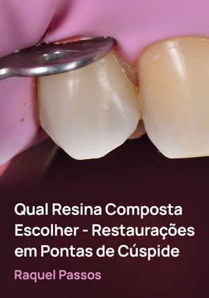 Cover for Qual Resina Composta Escolher - Restaurações em Pontas de Cúspide