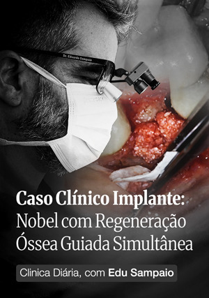 Cover for Caso Clínico Implante: Nobel com Regeneração Óssea Guiada Simultânea