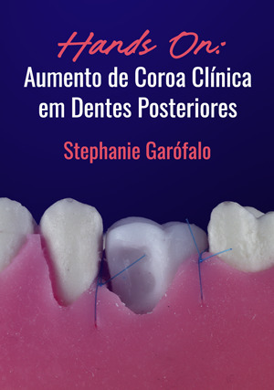 Cover for Hands on: Aumento de Coroa Clínica em Dentes Posteriores