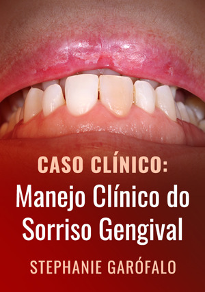Cover for Caso Clínico: Manejo Clínico do Sorriso Gengival