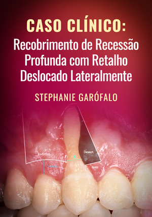Cover for Caso Clínico: Recobrimento de Recessão Profunda com Retalho Deslocado Lateralmente