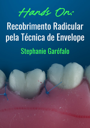 Cover for Hands on: Recobrimento Radicular pela Técnica de Envelope