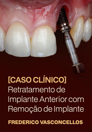 Cover for Caso Clínico: Retratamento de Implante Anterior com Remoção de Implante