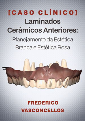 Cover for Caso Clínico: Laminados Cerâmicos Anteriores: Planejamento da Estética Branca e Estética Rosa