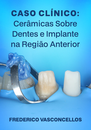 Cover for Caso Clínico: Cerâmicas sobre Dentes e Implante na Região Anterior