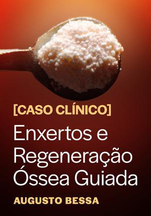 Cover for Caso Clínico: Enxertos e Regeneração Óssea Guiada