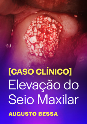 Cover for Caso Clínico: Elevação do Seio Maxilar