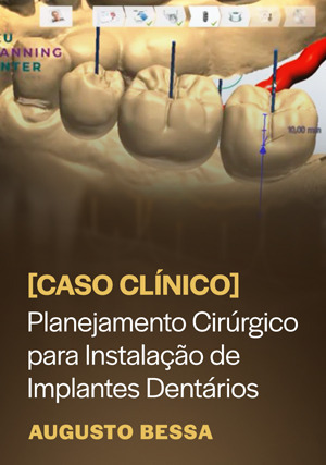 Cover for Caso Clínico: Planejamento Cirúrgico para Instalação de Implantes Dentários