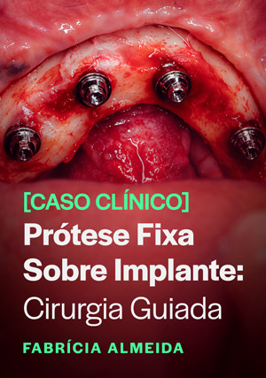 Cover for Caso Clínico - Prótese Fixa sobre Implante: Cirurgia Guiada