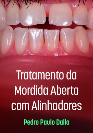 Cover for Tratamento da Mordida Aberta com Alinhadores