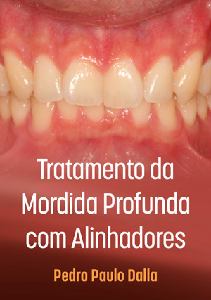 Cover for Tratamento da Mordida Profunda com Alinhadores
