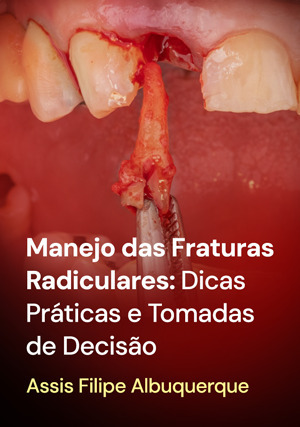 Cover for Manejo das Fraturas Radiculares: dicas práticas e tomadas de decisão