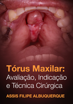 Cover for Tórus Maxilar: avaliação, indicação e técnica cirúrgica