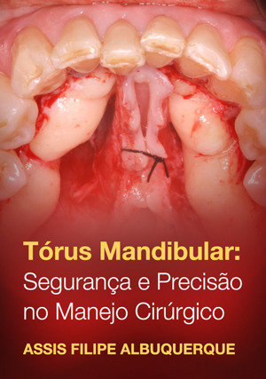 Cover for Tórus Mandibular: segurança e precisão no manejo cirúrgico