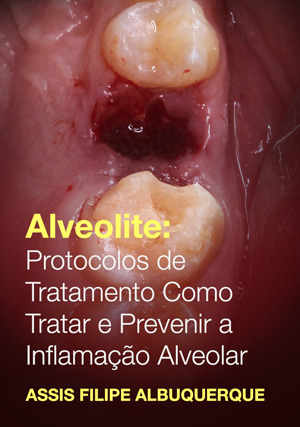 Cover for Alveolite: protocolos de tratamento Como tratar e prevenir a inflamação alveolar