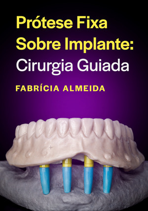 Cover for Prótese Fixa sobre Implante: Cirurgia Guiada