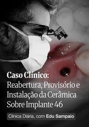 Cover for Clínica Diária, com Edu Sampaio - Caso Clínico: Reabertura, Provisório e instalação da Cerâmica sobre Implante 46