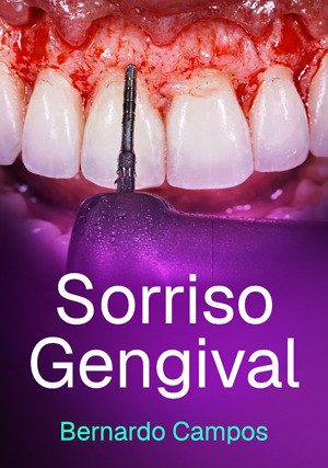 Cover for Sorriso Gengival