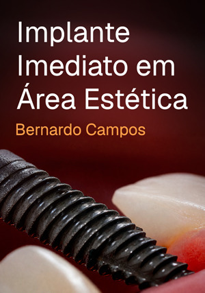 Cover for Implante Imediato em Área Estética