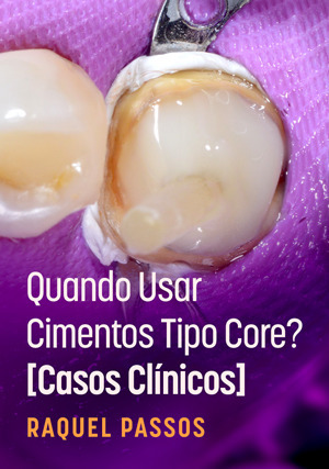 Cover for Quando Usar Cimentos Tipo Core? - Casos Clínicos