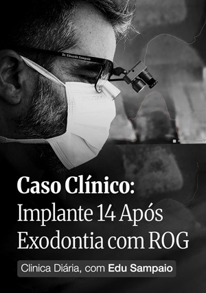 Cover for Clínica Diária, com Edu Sampaio - Caso Clínico: Implante 14 após Exodontia com ROG
